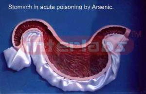 Stomach in acute poisoning by arsenic